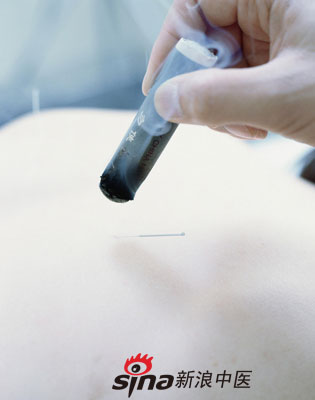 反復咳嗽 試試中醫特色療法